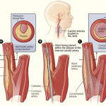 Glaucoma