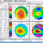 Glaucoma