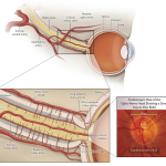 Glaucoma
