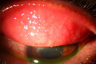 Qvision Proteínas y lentes de contacto 014053