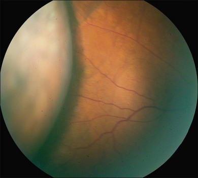 Inyección de hexafluoruro de azufre en la cámara anterior (SF6) para el manejo de la hipotonía posoperatoria en pacientes con glaucoma