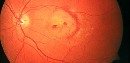 Eficacia y seguridad de la cirugía de catarata en la degeneración macular húmeda