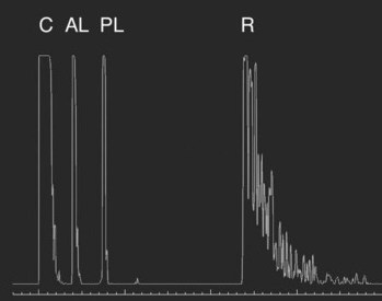 Biometría (1/4): del Ultrasonido a la OCT