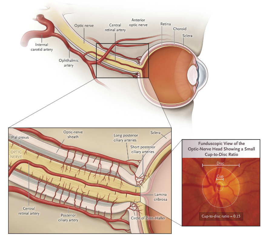 ¿La cabeza del nervio óptico se ve afectada por una punción lumbar diagnóstica?
