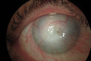 Qvision Infeccion por Acanthamoeba en usuarios de lentes de contacto Captura de pantalla 2010 11 21 a las 18.31.14