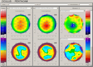 Qvision Corneal Warpage: ¿Cuánto tiempo antes tengo que quitarme las lentillas para hacerme las pruebas para operarme? Captura de pantalla 2012 11 16 a las 10.39.27
