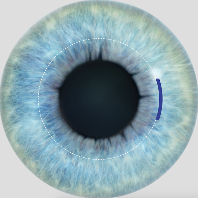 ReLEx SMILE no produce afectación a las células endoteliales de la córnea