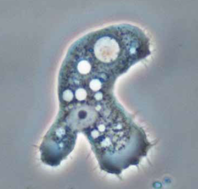 Queratitis por acanthamoeba en usuarios de lentes de contacto