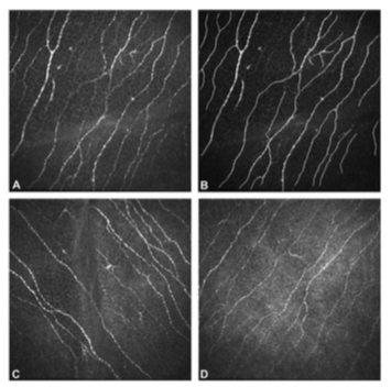 Efectos a largo plazo de las lentes de contacto blandas en el menisco lagrimal