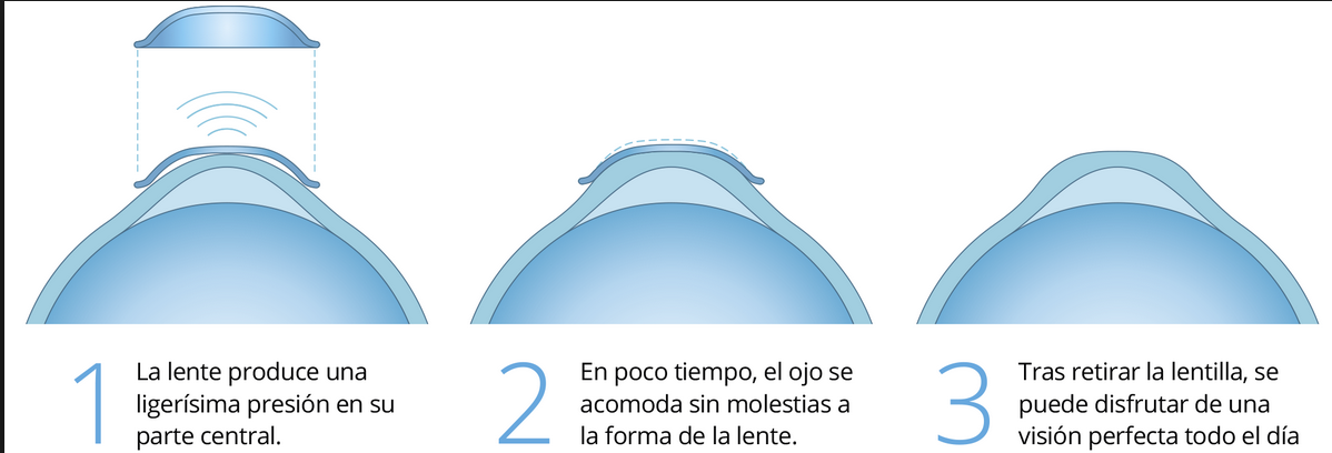 Orto-k: ¿Existe mayor riesgo de queratitis bacteriana?