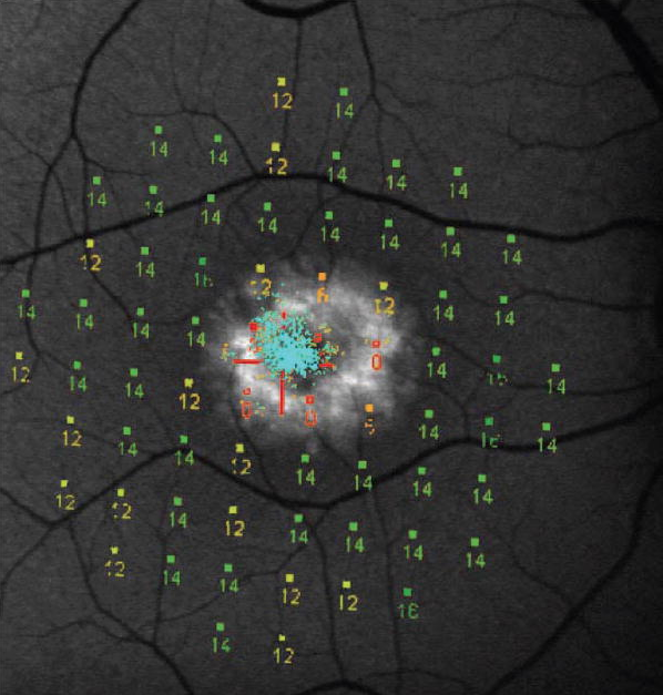 Preferred retinal locus (PRL) en patología macular: la importancia de la microperimetría.