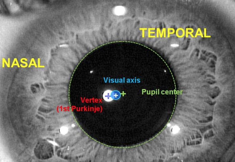 (4/7) ¿Es importante el Ángulo Kappa en Cirugía Refractiva, de Presbicia y Cataratas?: Centrado Cirugía Refractiva Láser Corneal 2 (LASIK y PRK II: La Evidencia)