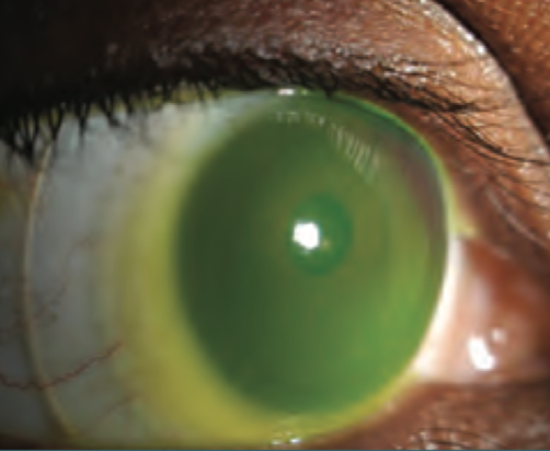Evaluación clínica con diferentes tipos de lentes de contacto en el manejo del Queratocono