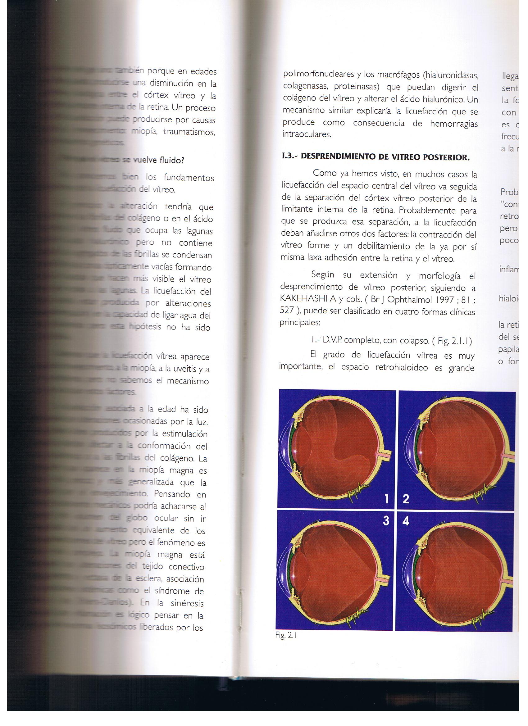 ¿En qué consiste un desprendimiento vítreo posterior y un desprendimiento vítreo posterior incompleto o anómalo?