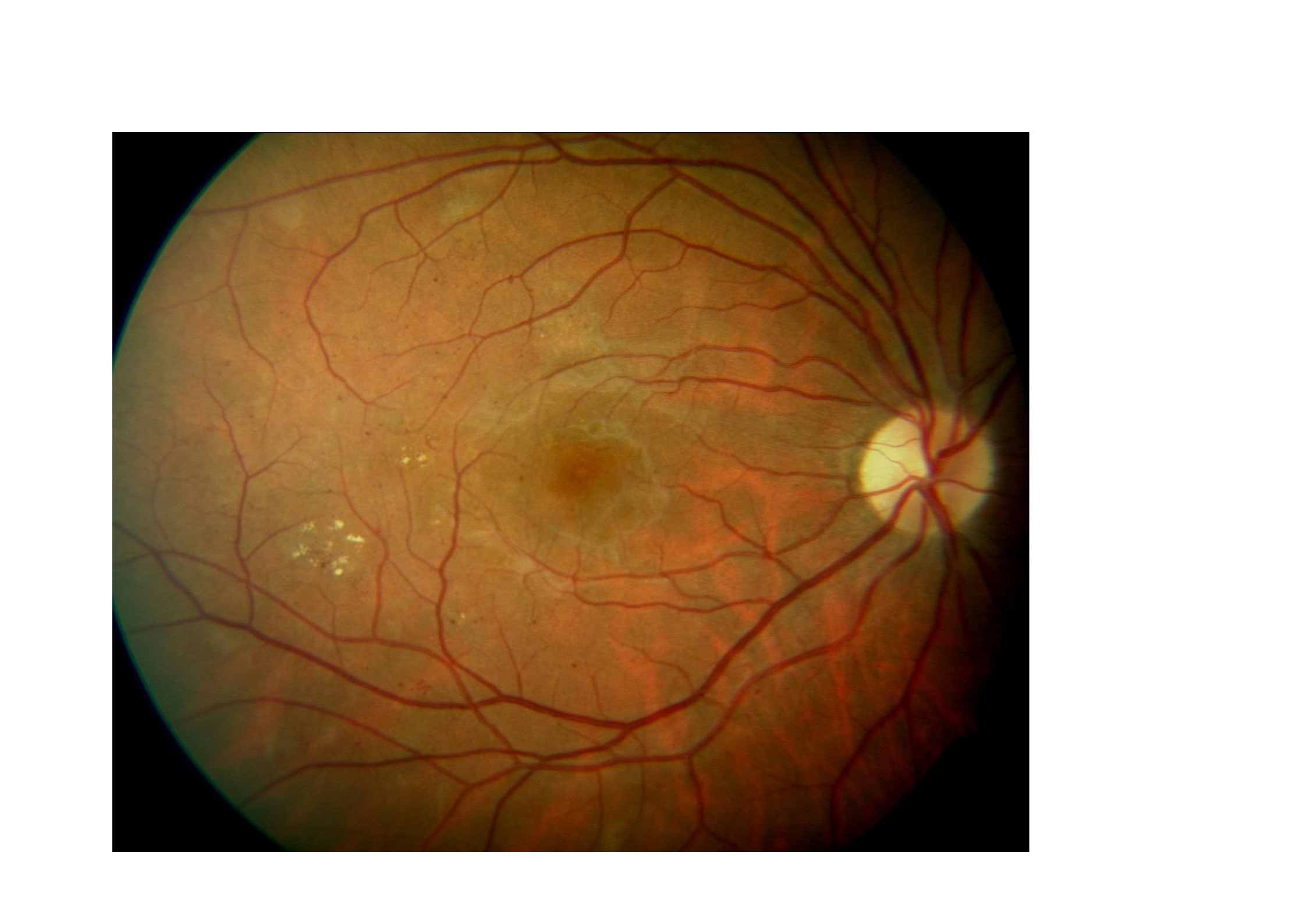 El fenofibrato podría reducir la progresión de la retinopatía diabética.