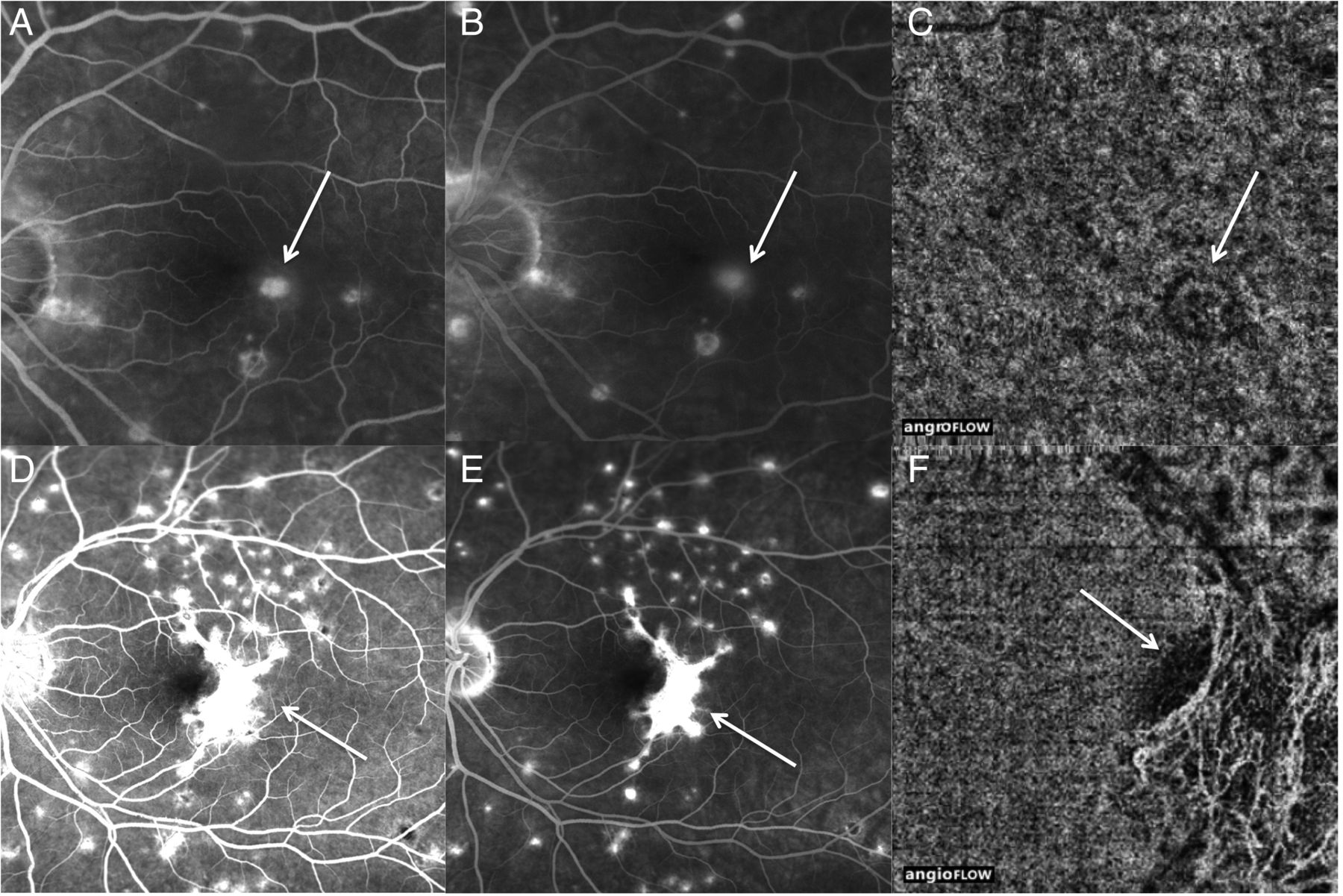 Resultado de imagen de multifocal choroiditis