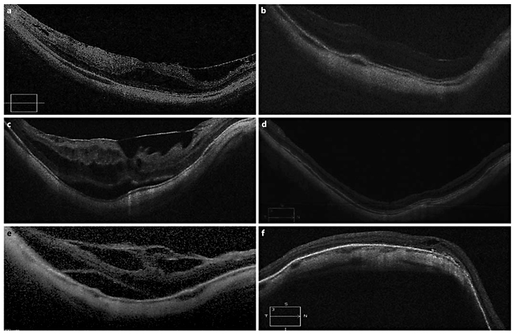 Figure 2: Preoperative OCT of patient 6 showed isolated foveoschisis. b Postoperative OCT 10 months after PPV and ILM peeling showed resolution of foveoschisis. c Preoperative OCT of patient 1 showed foveoschisis and foveal detachment. d Postoperative OCT showed complete resolution of foveoschisis and foveal detachment 5 months after PPV, ILM peeling and gas tamponade. e Preoperative OCT of patient 3 showed foveoschisis and foveal detachment. f Postoperative OCT 1 month after PPV, ILM peeling, gas tamponade and Ando plombe showed almost complete resolution of the foveoschisis. 242 × 155 mm (150 × 150 DPI).