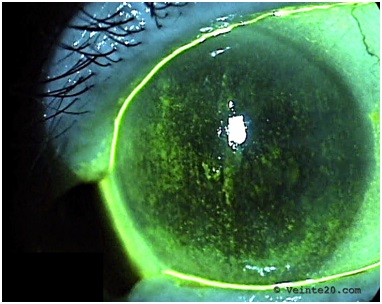 Calidad visual y ojo seco 1/2