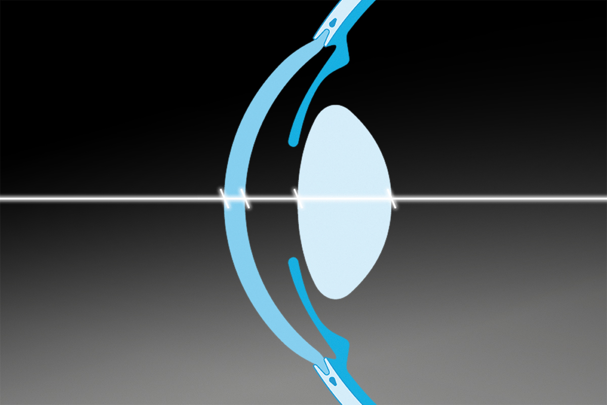 ¿Afecta la iluminación en la toma de medidas de parámetros oculares?