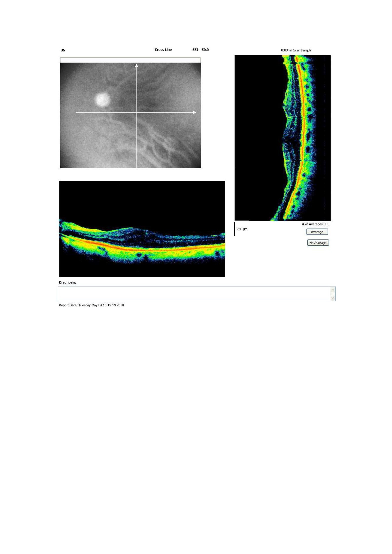 El contorno foveal podría tener valor pronóstico en la cirugía de la membrana epirretiniana.