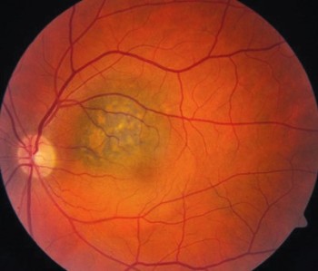 Nevus Coroideo: Factores de Riesgo para Malignización