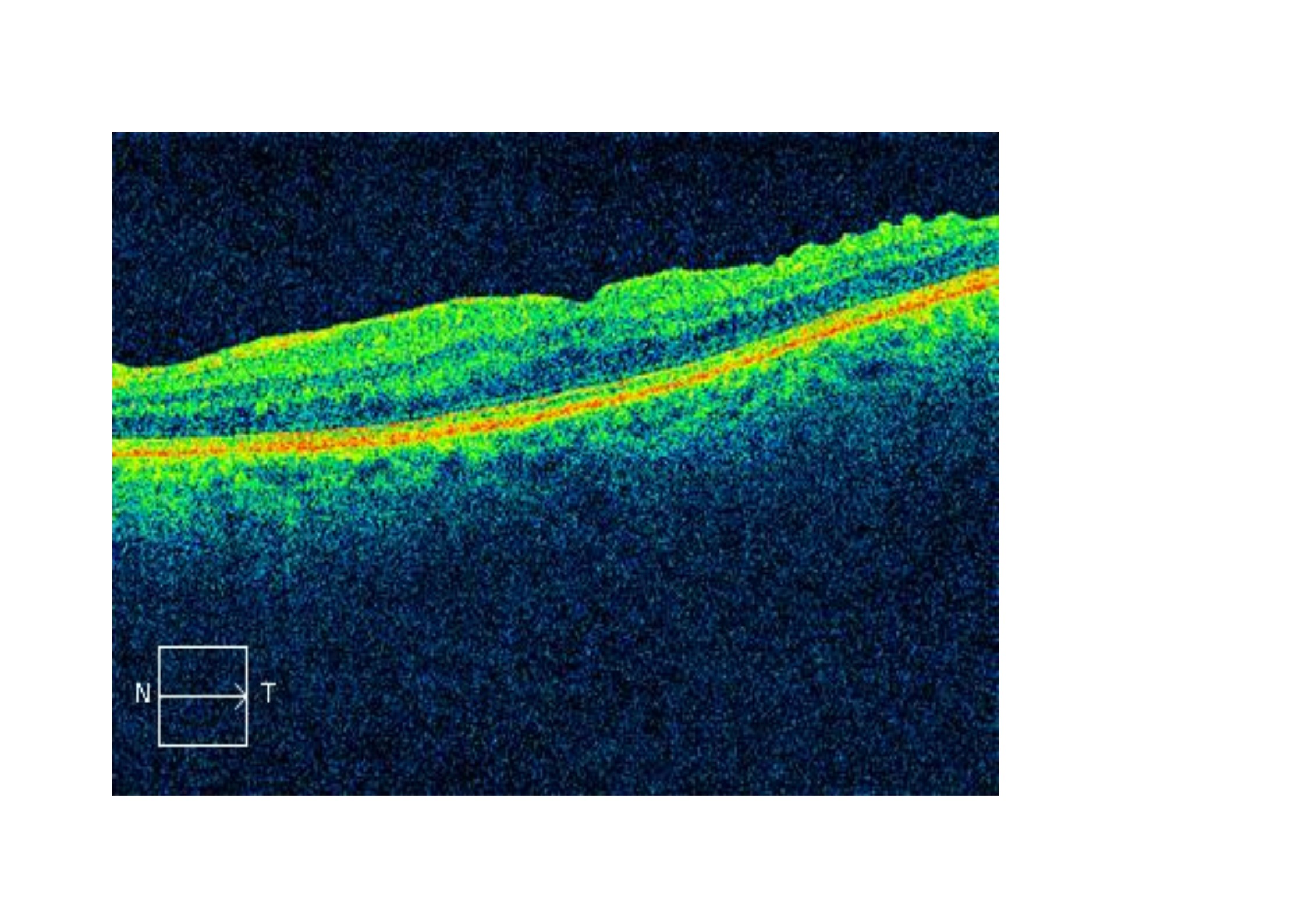El 41% de los pacientes con uveítis presenta membrana epirretiniana.