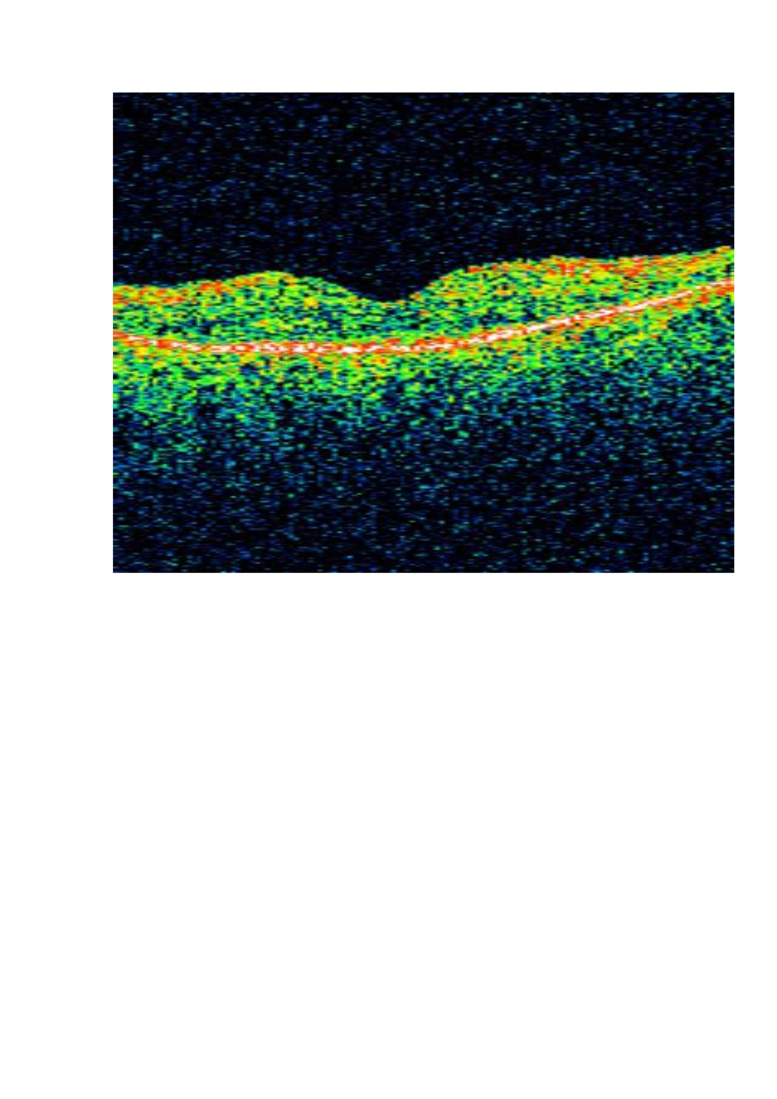 ¿Cómo podemos ayudar a los pacientes afectados de retinosis pigmentaria?