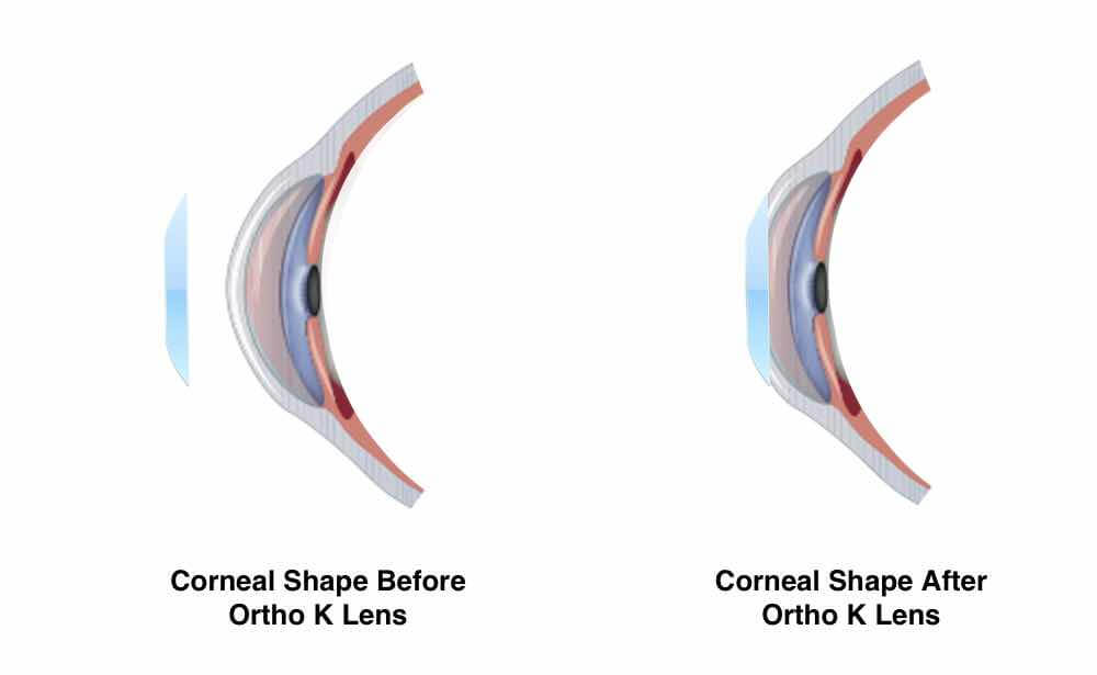 Resultado de imagen de orthokeratology
