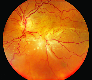 Resultado de imagen de retinal pvr