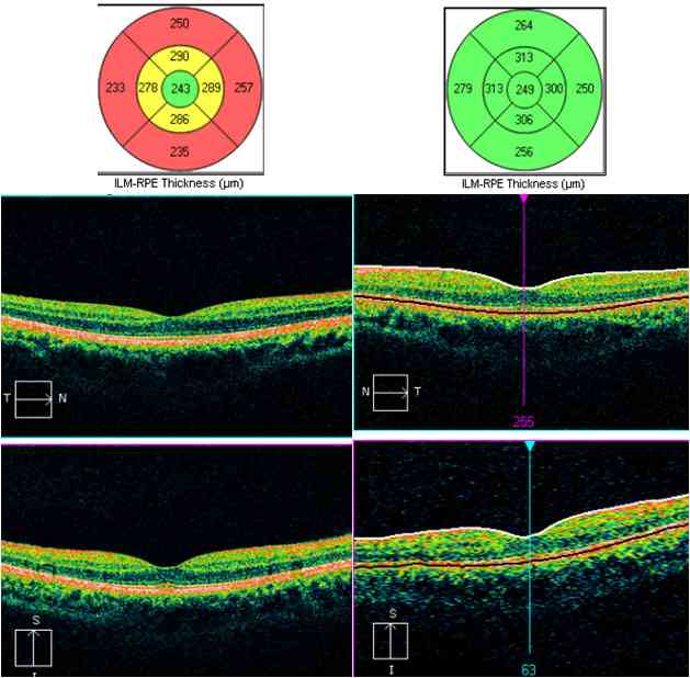 Resultado de imagen de oct retina atrophy