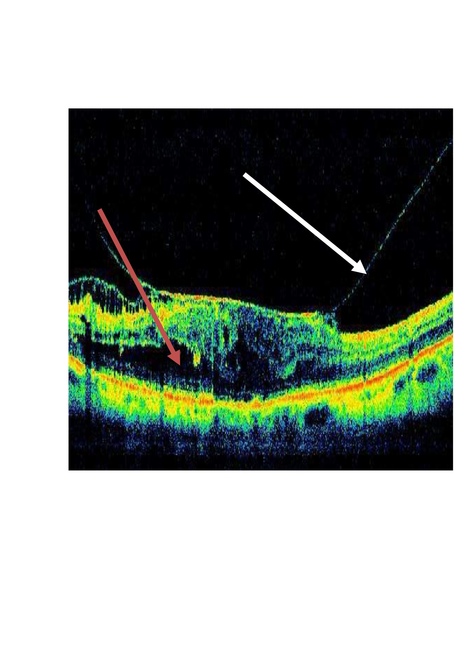 ¿Cómo tratamos el síndrome de tracción vítreo-macular?