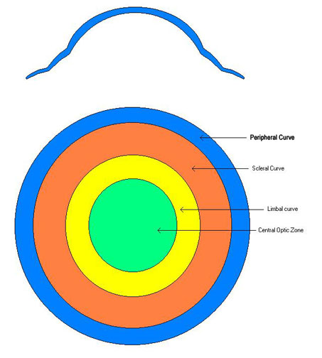 Lentes de contacto esclerales y su relación con el ojo seco en Queratocono