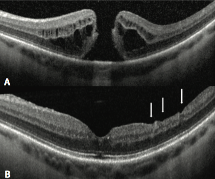 Resultado de imagen de macular hole