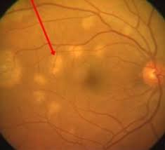 SINDROME DE LOS PUNTOS BLANCOS EVANESCENTES