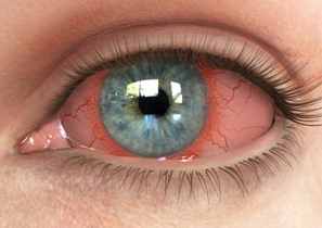Resultado de imagen de uveitis sintomas
