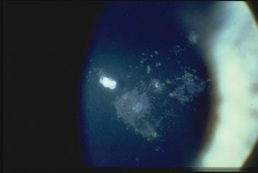 Proteínas y lentes de contacto