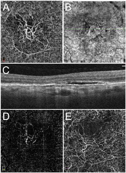 Type I choroidal neovascularization (CNV) in exudative age-related macular degeneration in the right eye of a 67-year-old woman, status post 9 ranibizumab injections and 13 aflibercept injections. (A) 3 × 3 mm spectral domain optical coherence tomographic (SD-OCT) angiogram of the choriocapillaris showing a neovascular membrane centrally; (B) en face structural optical coherence tomography (OCT) of the same area showing patchy hyperreflectivity, with hyporeflectivity corresponding to subretinal