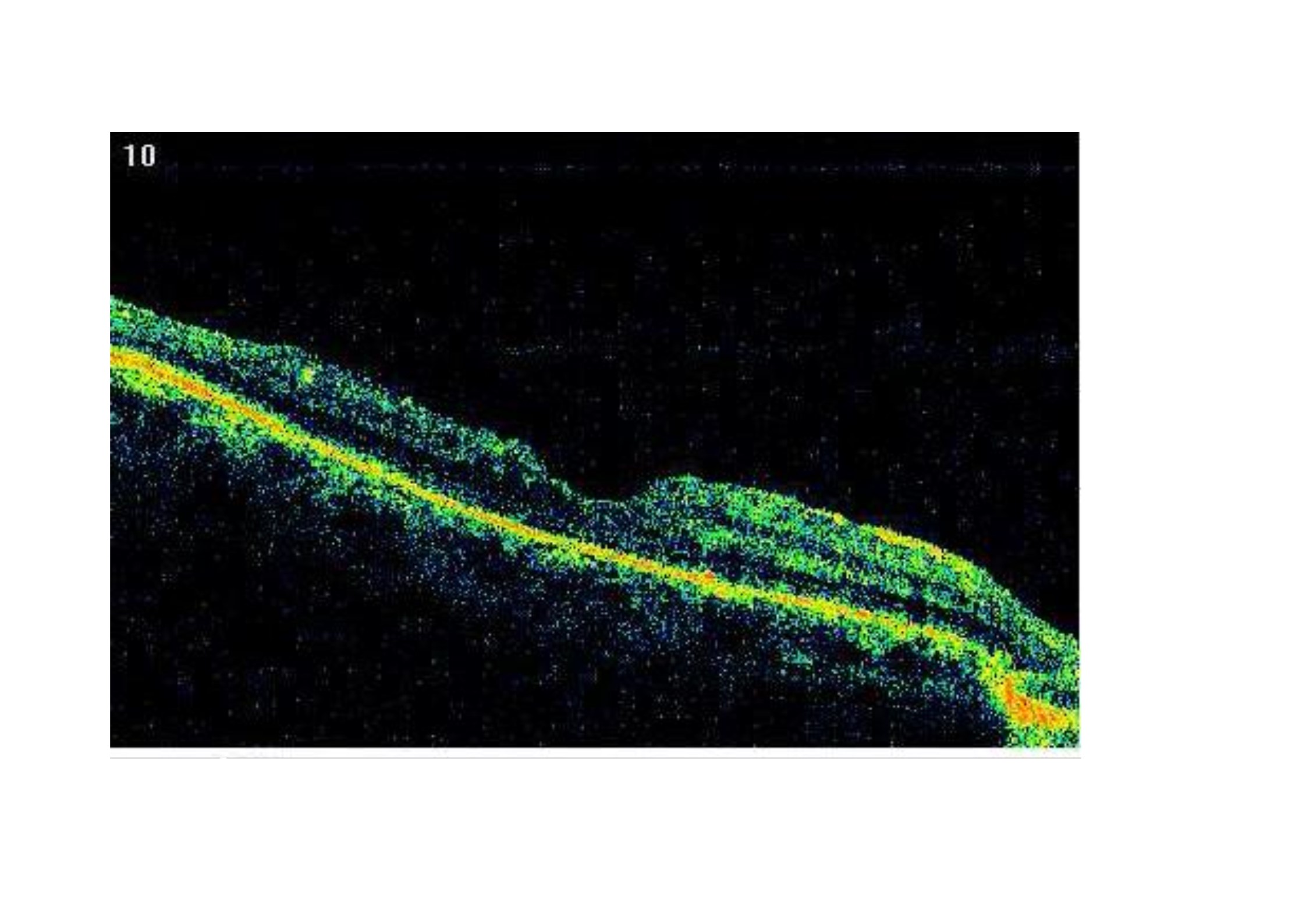 Nuevos hallazgos en la etiopatogenia del agujero lamelar.