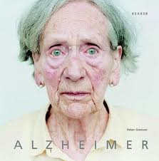Alzheimer: variante visual