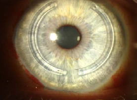 anillos intraestromales