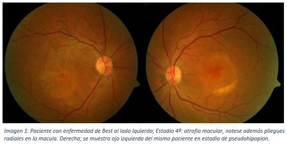 OCT en Distrofia Macular Viteliforme