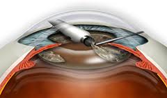 ¿Deben operarse de cataratas los pacientes con Degeneración Macular Asociada a la Edad (DMAE)?