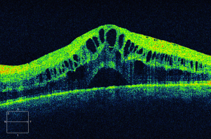 Resultado de imagen de macular edema treatment