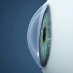 Qvision El Cross-Linking corneal en niños con queratocono mejora la agudeza visual cornea normal