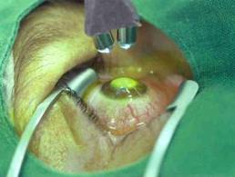 Influencia del uso de lentes de contacto en los resultados de cross-linking en Queratocono progresivo.
