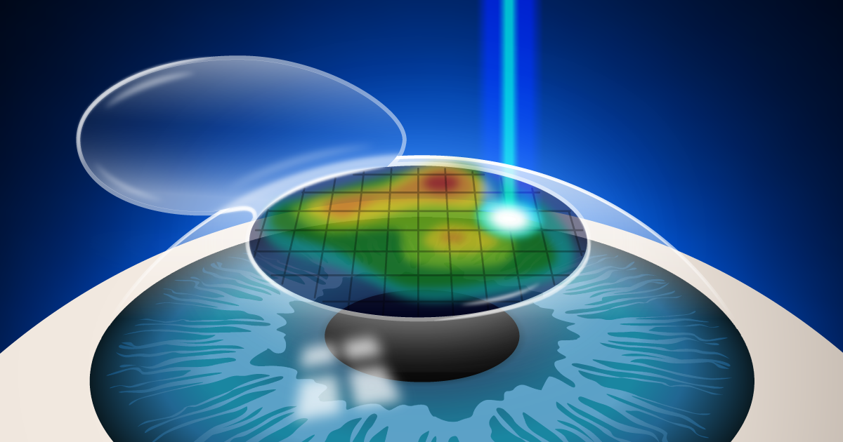 (1/4) ICL Evidence-Based: ¿Cirugía Refractiva con Láser Excimer ó Lentes Fáquicas para corregir Miopía > 6 Dioptrías?