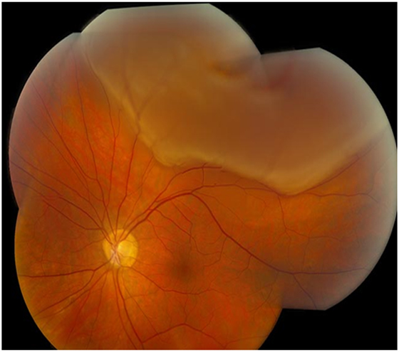 Resultado de imagen de desprendimiento de retina