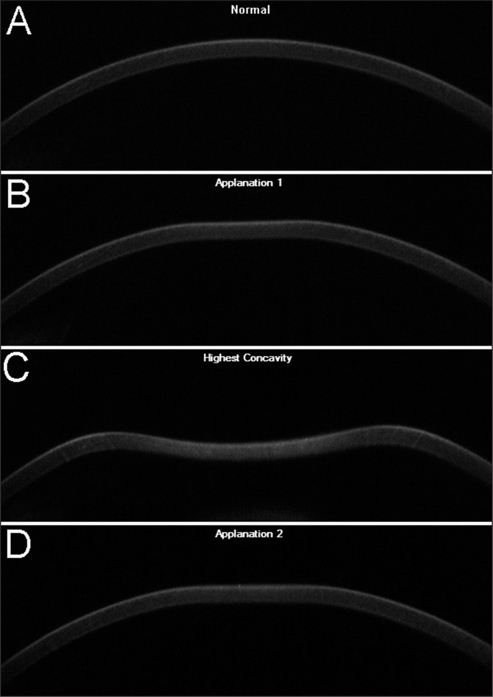 (2/2) ReLEx SMILE y Biomecánica Corneal