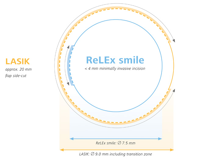 ReLEx SMILE: no incrementa la elevación de la cara posterior en miopías moderadas-severas a largo plazo.