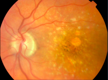 Uso de prismas para la rehabilitación visual en pacientes con Baja Visión, después de la pérdida de la función macular.